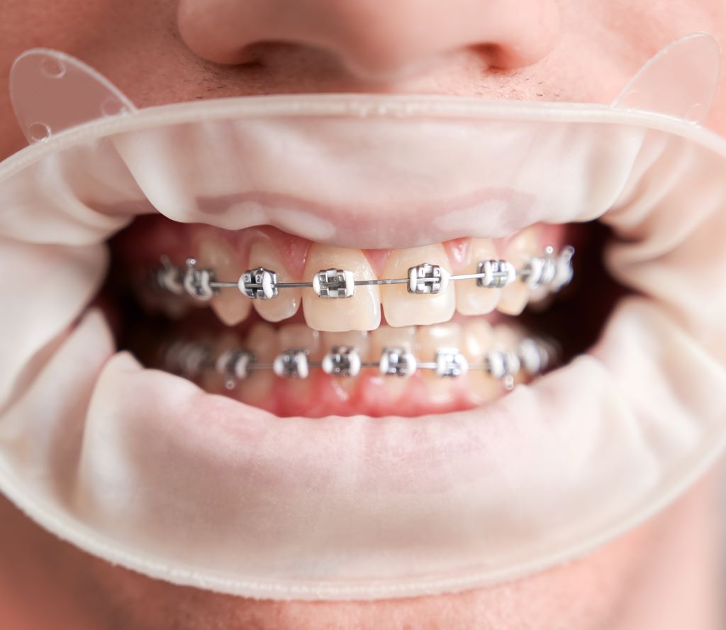 Metal vs Ceramic Braces Services in Chandler Metal vs Ceramic Braces Services in Chandler