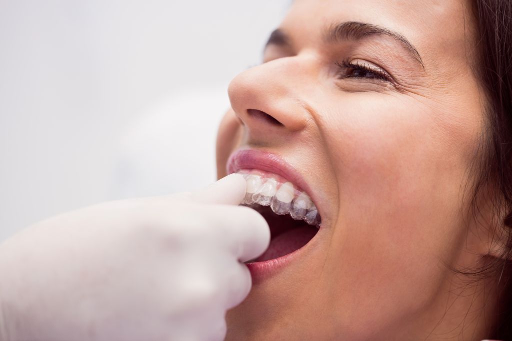 Navigating Invisalign Challenges