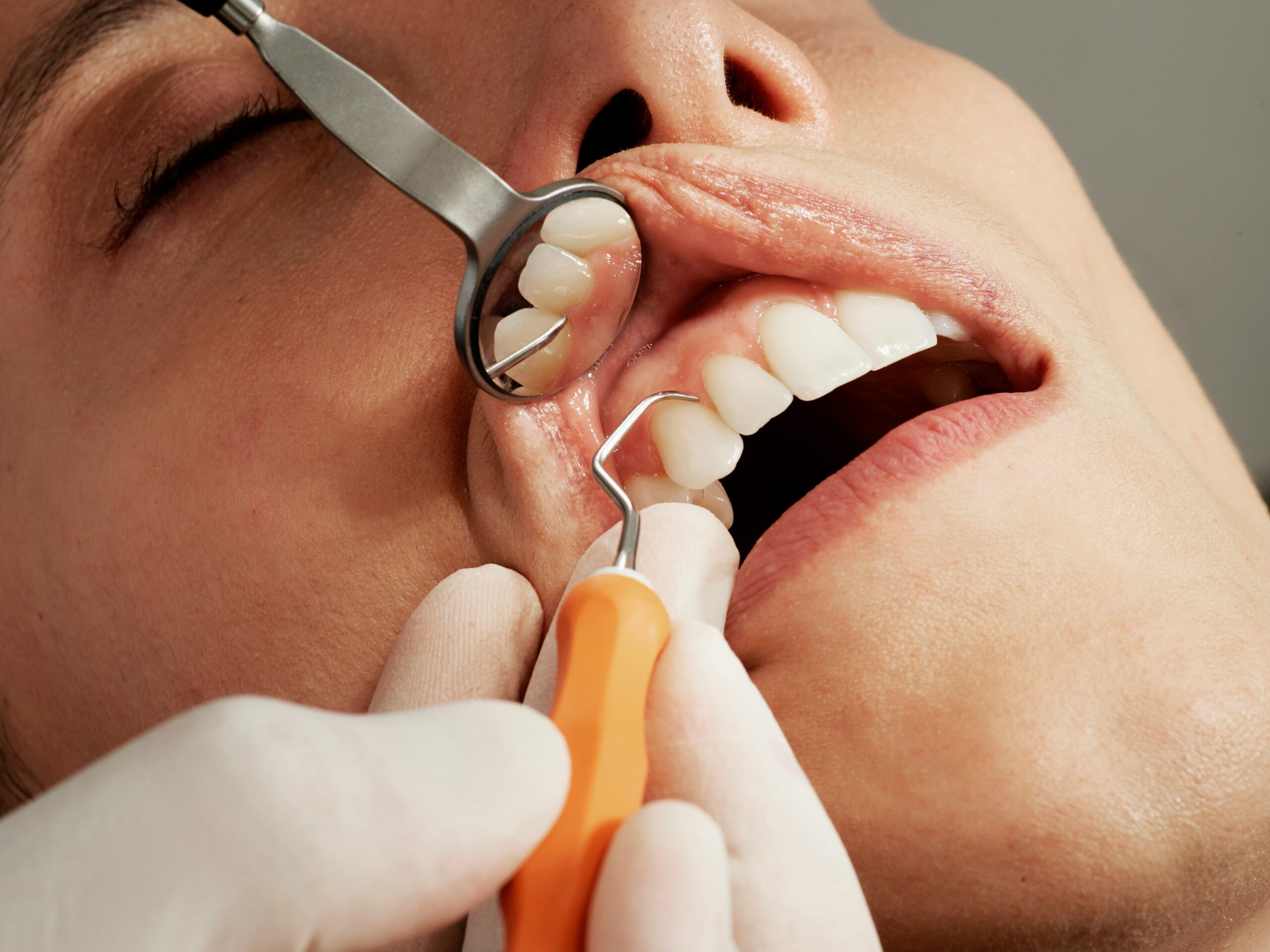 Deep Cleaning vs Surgery for Gum Disease Dentist performing gum treatment procedure